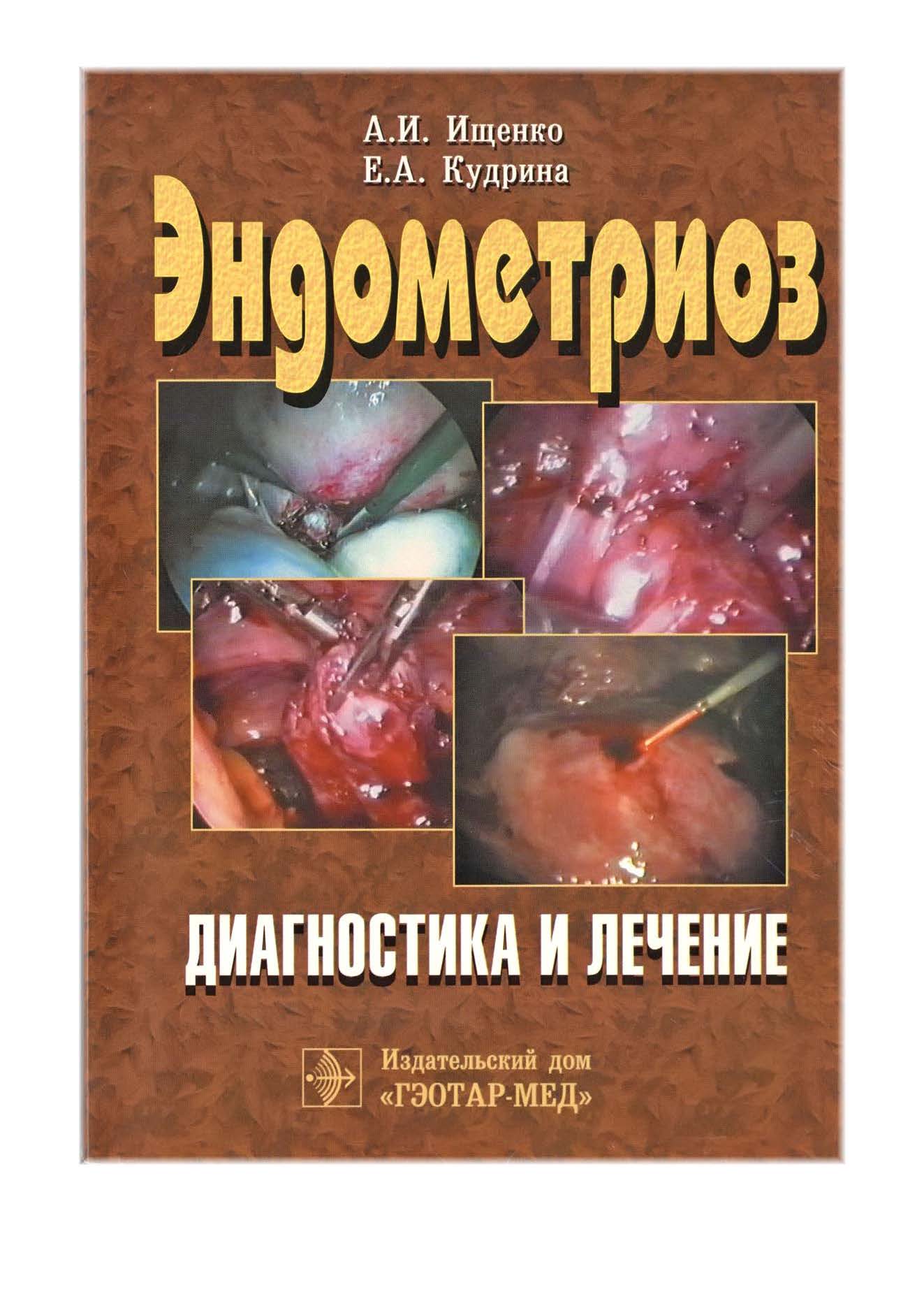 ЭНДОМЕТРИОЗ