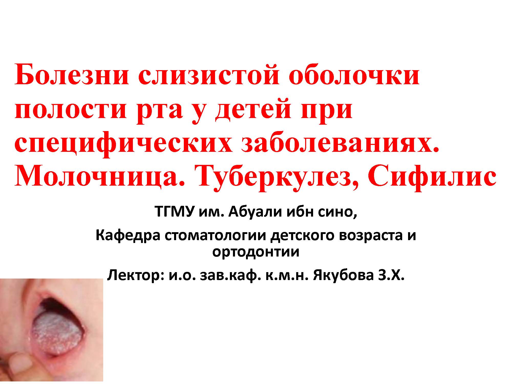 Болезни слизистой оболочки полости рта у детей при специфических заболеваниях. Молочница.